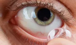 Kontakt lens kullanıyorsanız bu 6 kuralı uygulayın: Hayat kurtarıyor