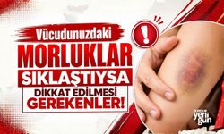 Vücudunuzdaki morluklar sıklaştıysa dikkat edilmesi gerekenler!